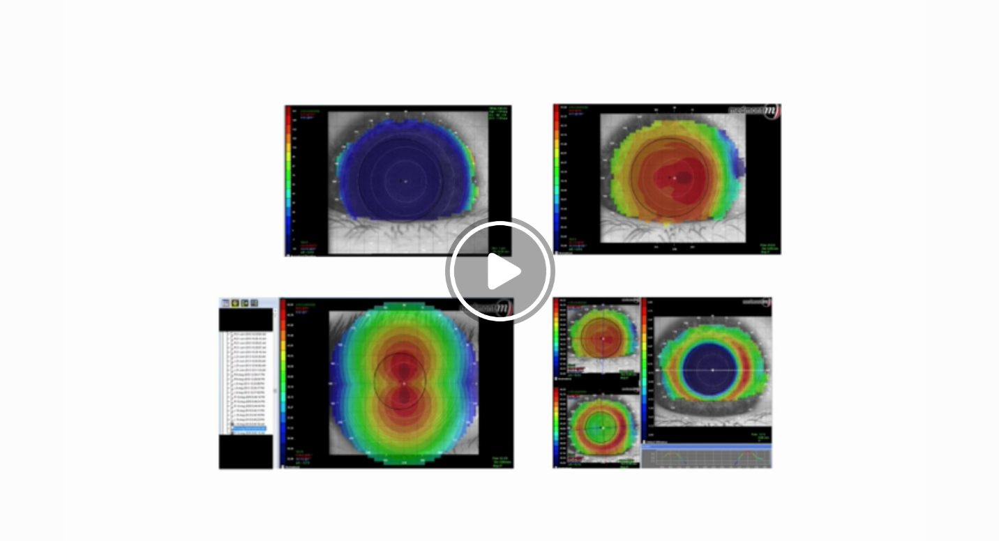 Episode 52: Corneal Topography: What is This Colorful Map Telling Me?