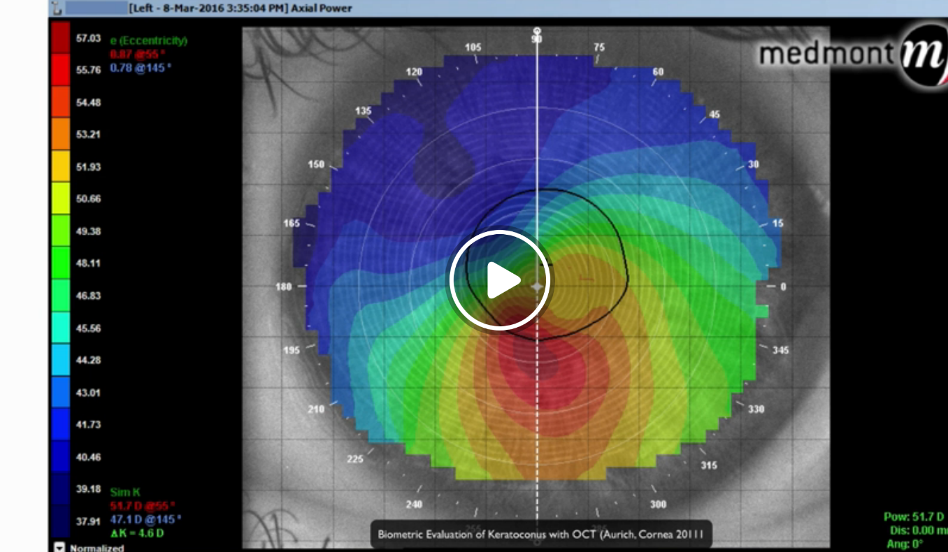 Episode 54: OCT for Keratoconus