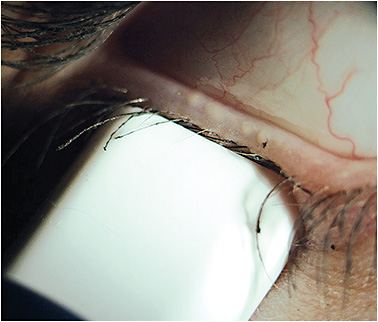 Figure 1. A calibrated pressure is being applied to the lower lid. Within the area of the meibomian gland evaluator, four glands are actively expressing oils.